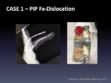 CASE 1: PIP Fx-Dislocation