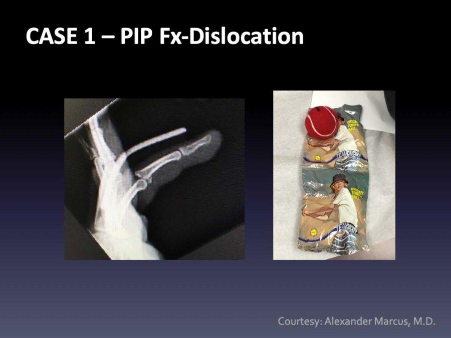 CASE 1: PIP Fx-Dislocation