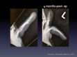 CASE 1: PIP Fx-Dislocation