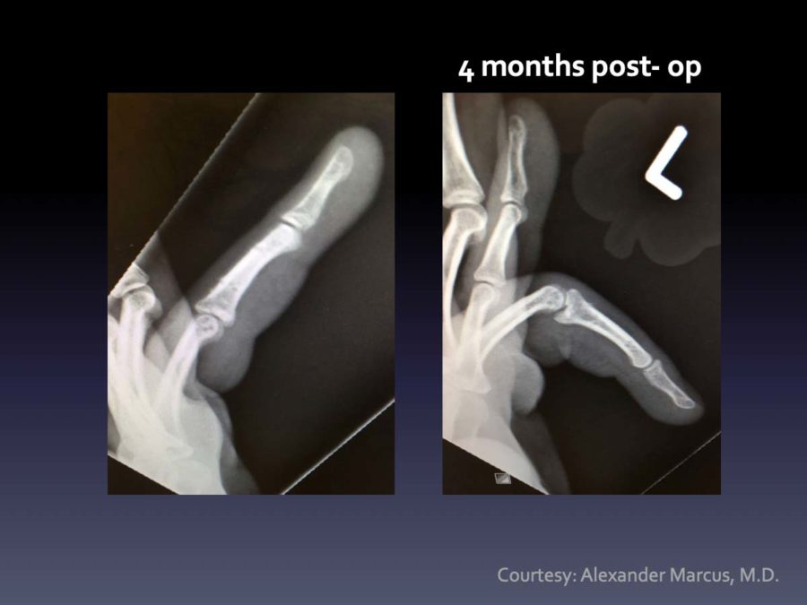 CASE 1: PIP Fx-Dislocation