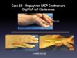 Case 10: Dupuytren MCP Contracture DigiFix® w/ Elastomers