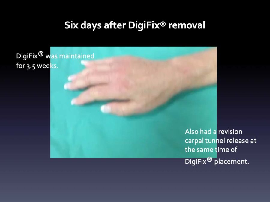 Case 10: Six days after DigiFix® removal