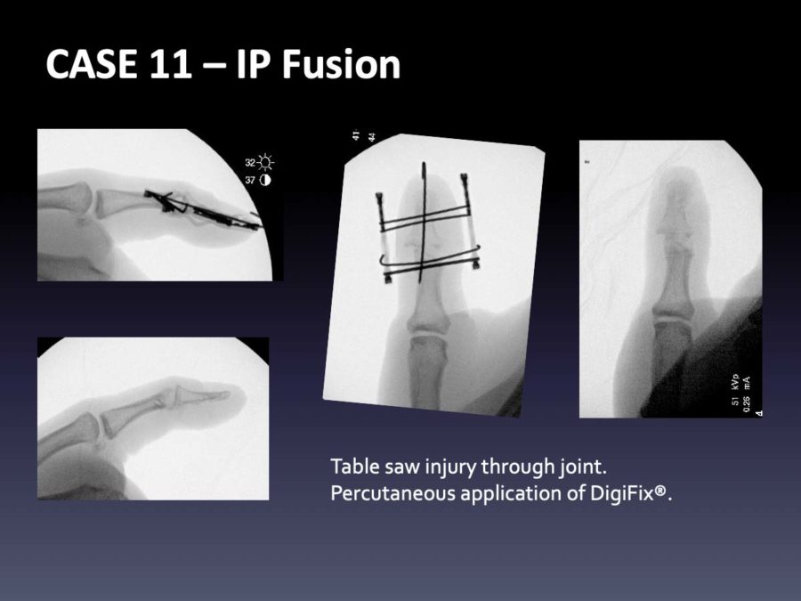 CASE 1: IP Fusion