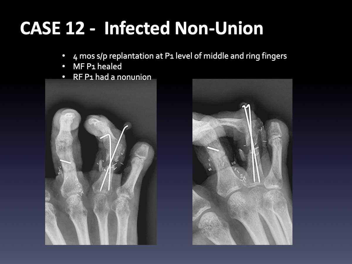CASE 12:  Infected Non-Union