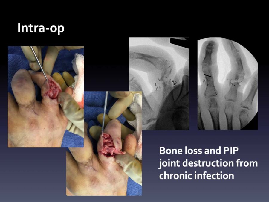 CASE 12:  Infected Non-Union