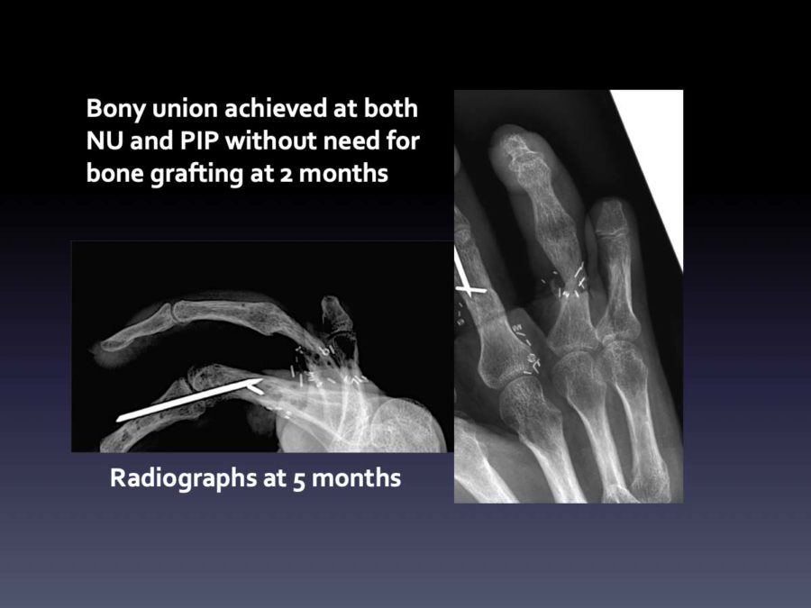 CASE 12:  Infected Non-Union