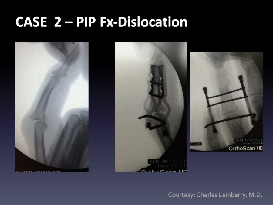 CASE  2: PIP Fx-Dislocation