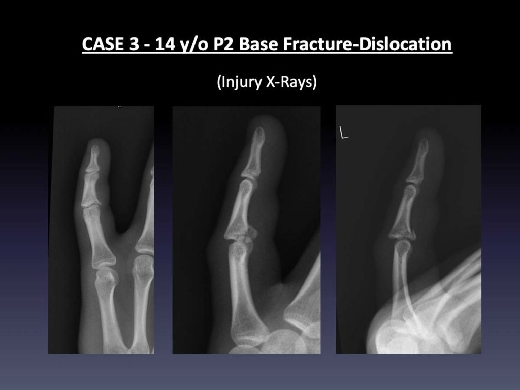 Pip fracture dislocation archives virak orthopedics