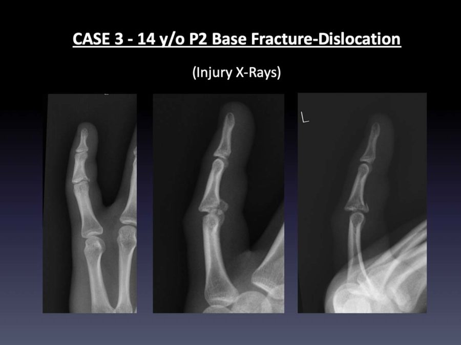 CASE 3: 14 y/o P2 Base Fracture-Dislocation