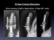 CASE 3: 14 y/o P2 Base Fracture-Dislocation