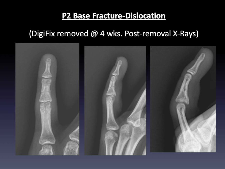 CASE 3: 14 y/o P2 Base Fracture-Dislocation