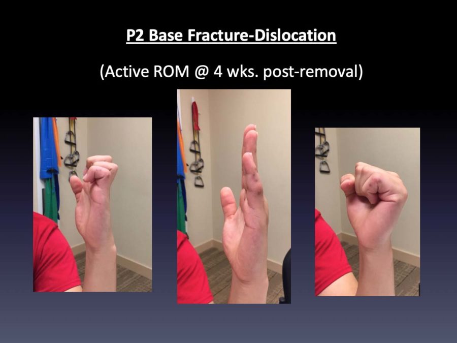 CASE 3: 14 y/o P2 Base Fracture-Dislocation