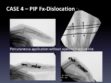 CASE 4: PIP Fx-Dislocation