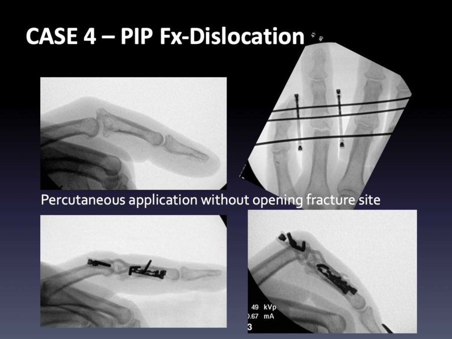 CASE 4: PIP Fx-Dislocation