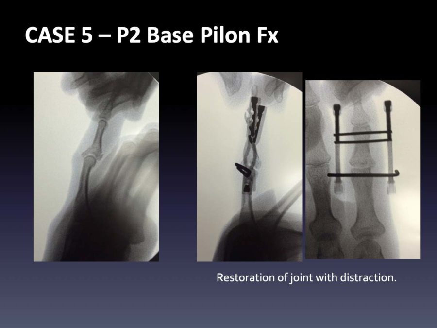 CASE 5: P2 Base Pilon Fx