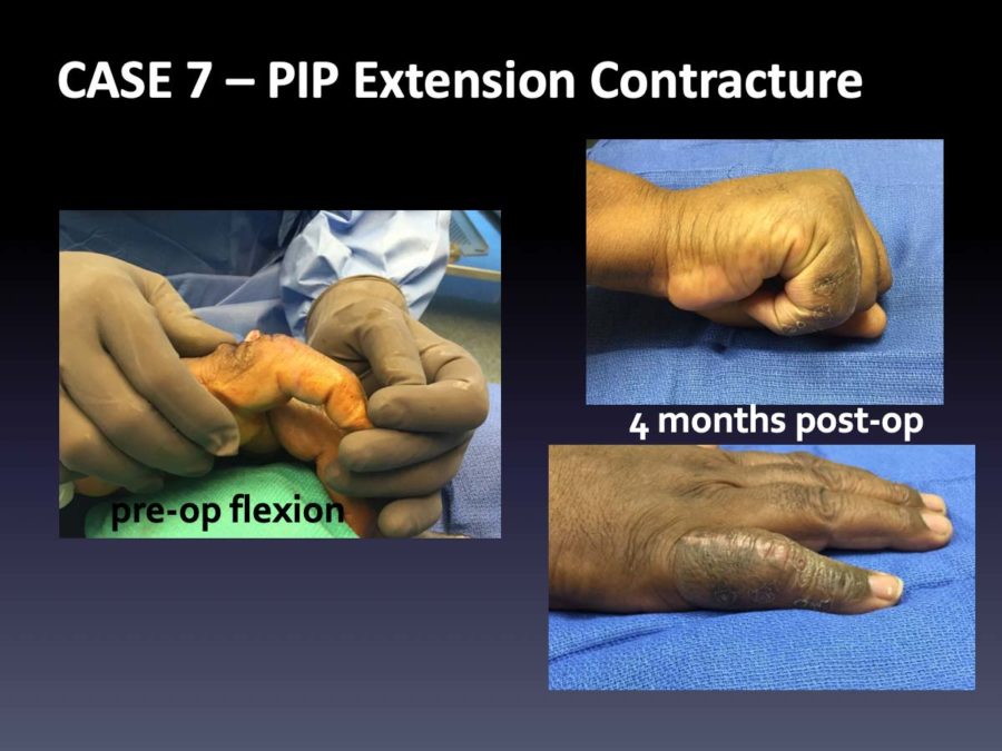 CASE 7: PIP Extension Contracture