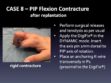 CASE 8: PIP Flexion Contracture after Replantation