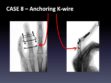 CASE 8: Anchoring K-wire