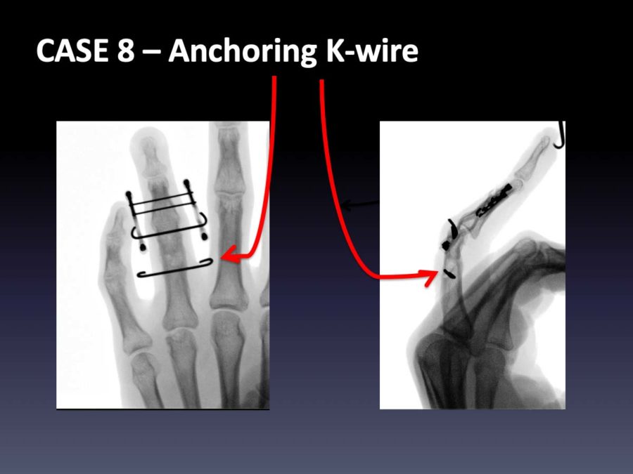 CASE 8: Anchoring K-wire