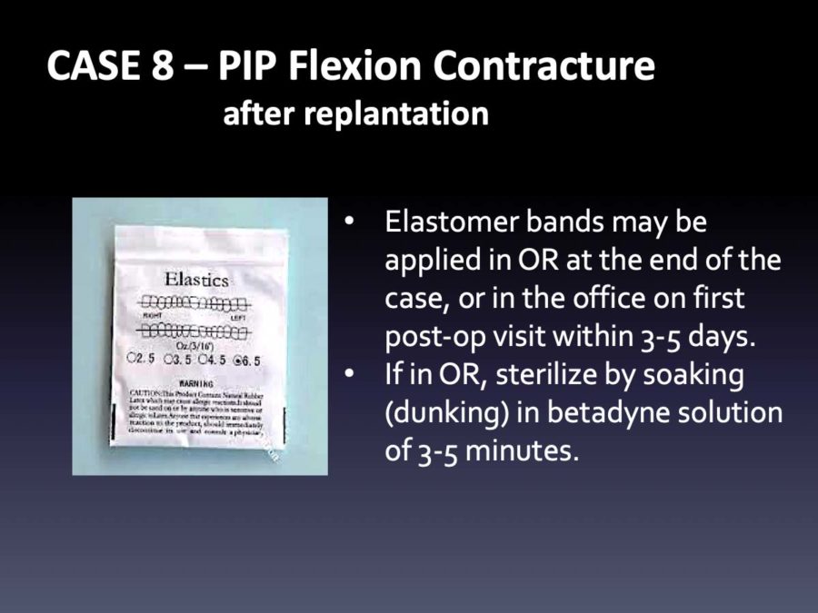 CASE 8: PIP Flexion Contracture after Replantation