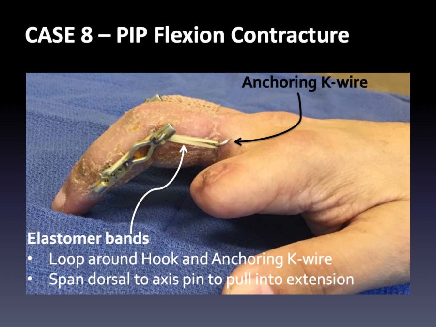 CASE 8: PIP Flexion Contracture