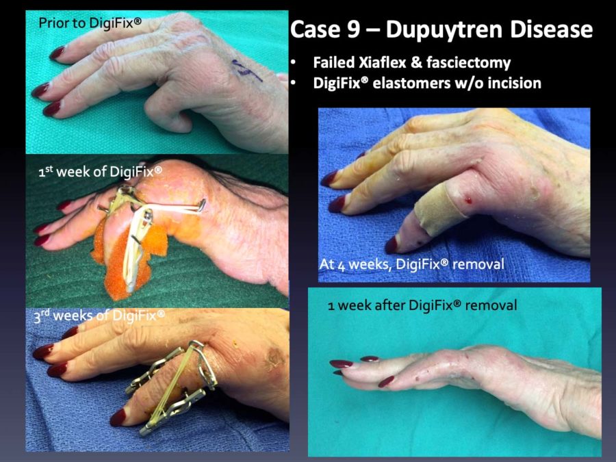 Case 9: Dupuytren Disease