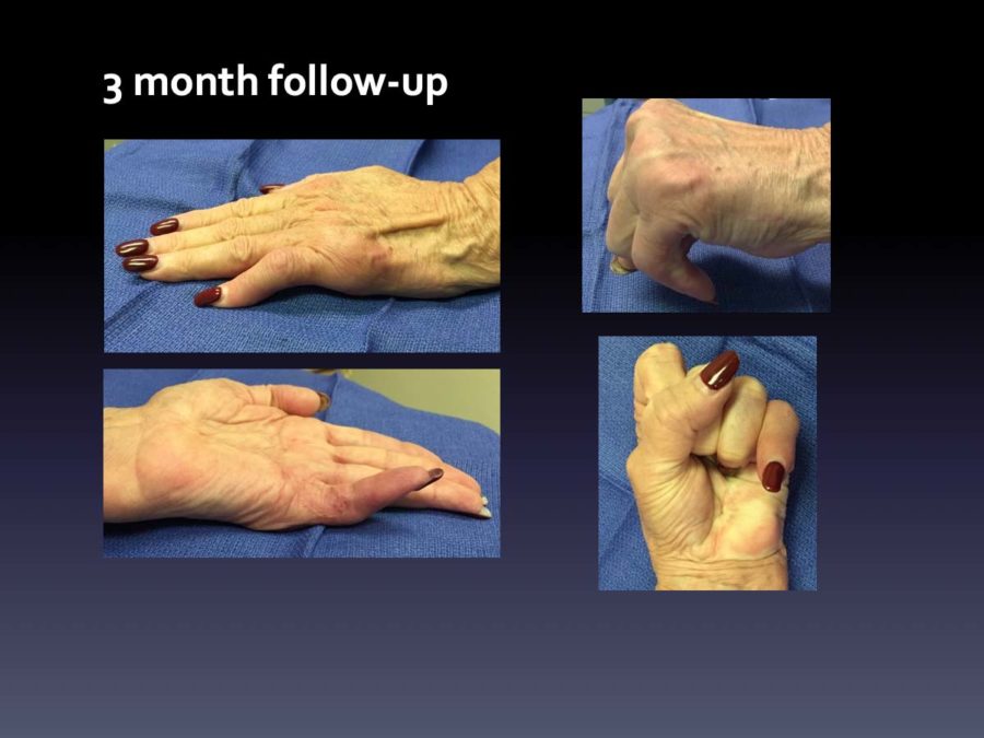 Case 9: Dupuytren Disease