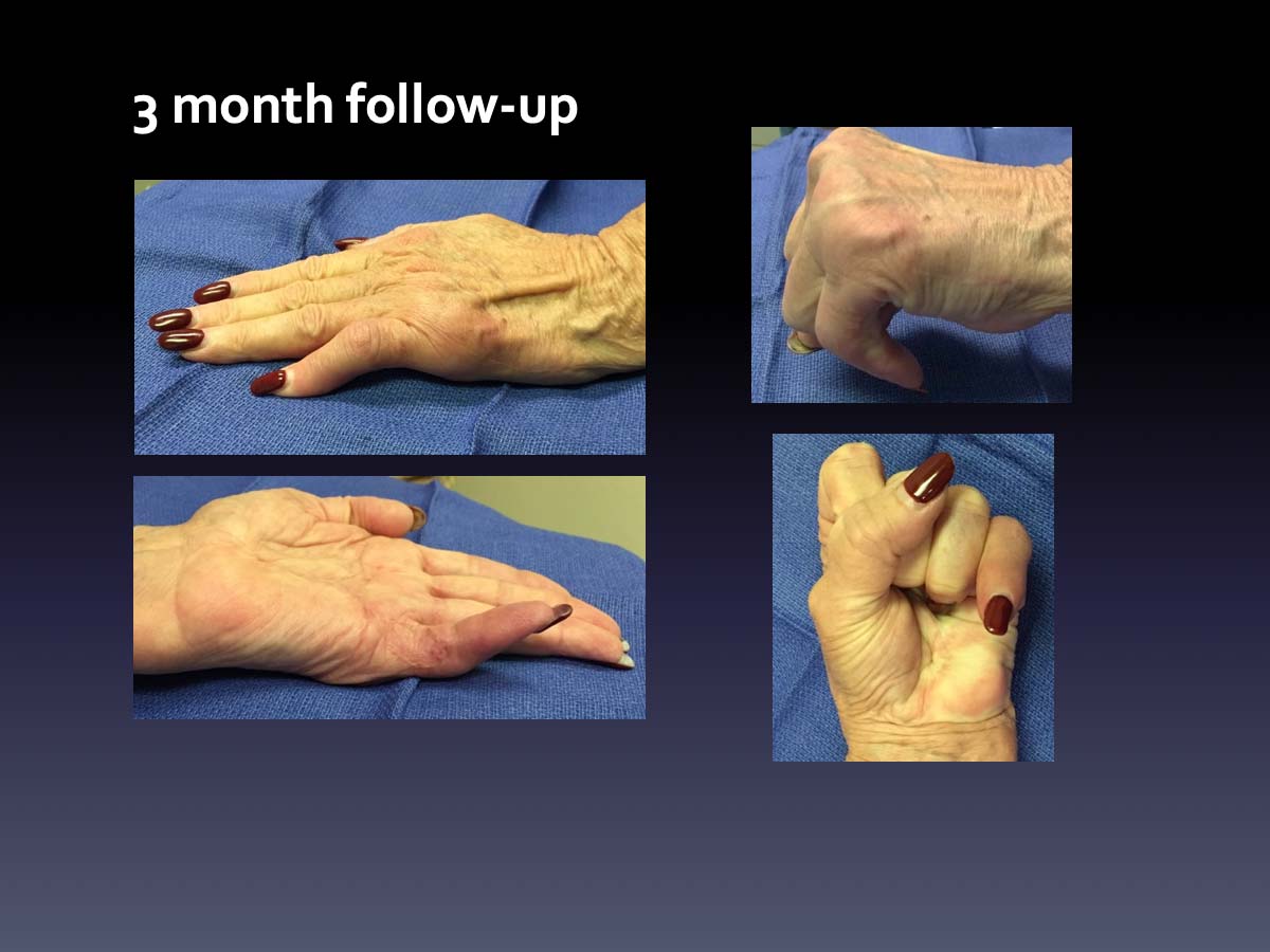 Case 9: Dupuytren Disease - Virak Orthopedics