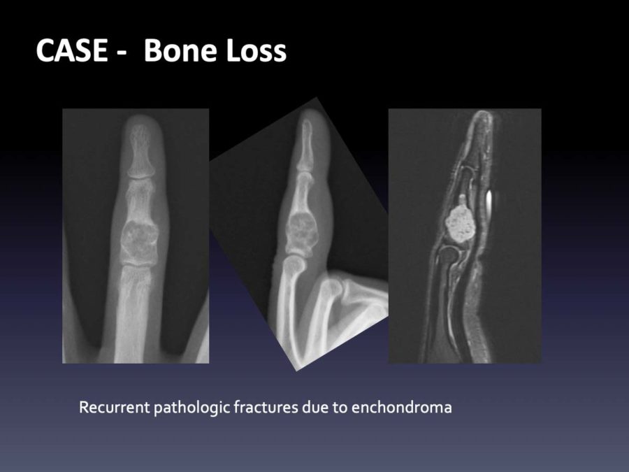 CASE: Bone Loss