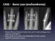CASE: Bone Loss