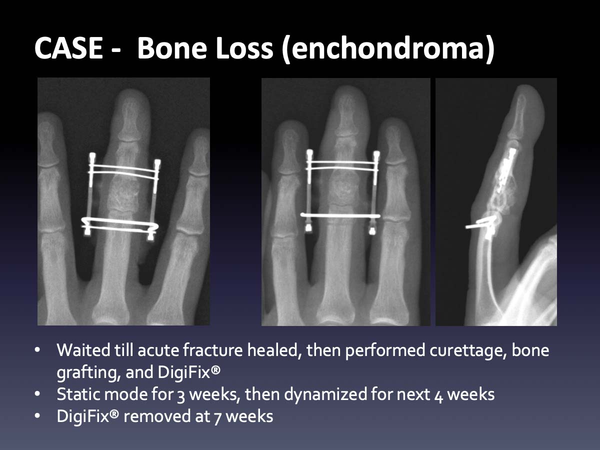 CASE: Bone Loss - Virak Orthopedics