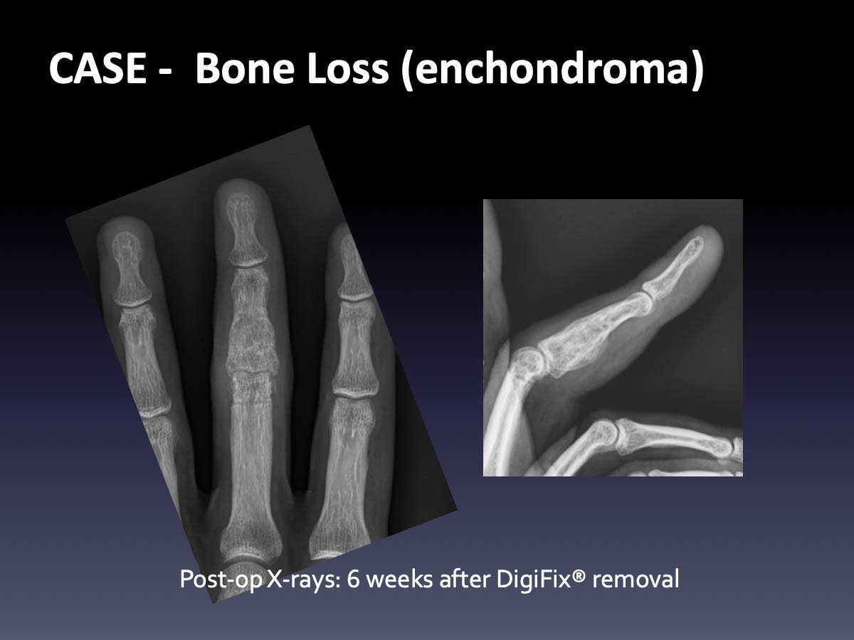 CASE: Bone Loss - Virak Orthopedics