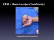 CASE: Bone Loss