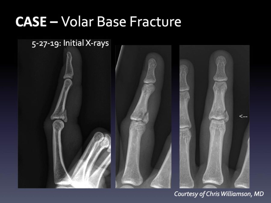 CASE: Delayed Dislocation