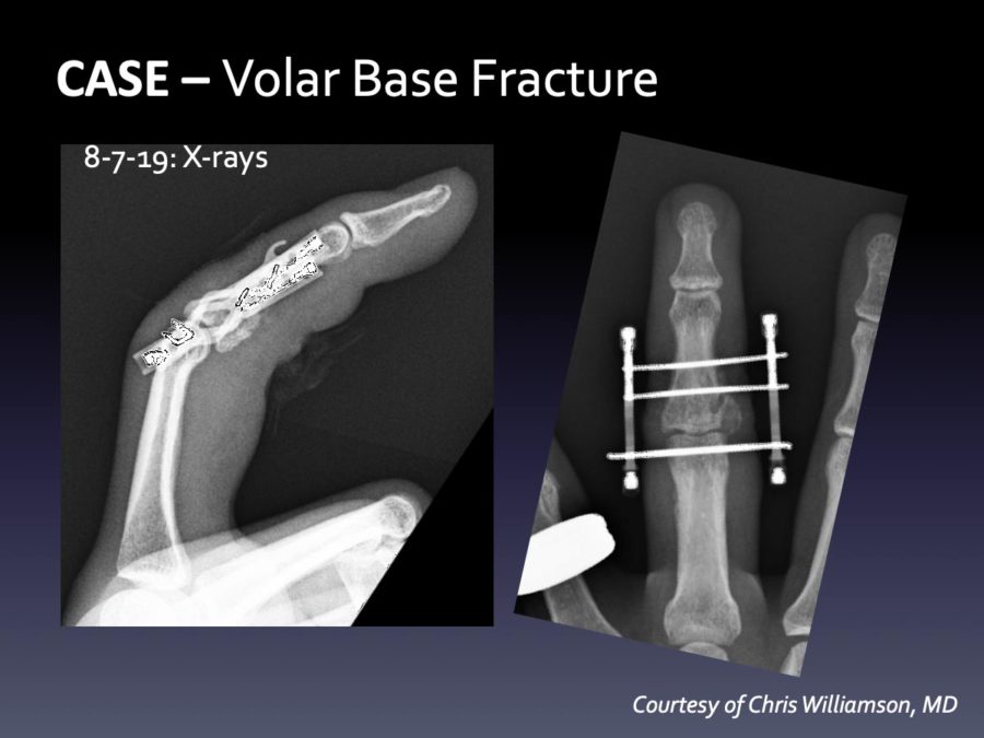 CASE: Delayed Dislocation