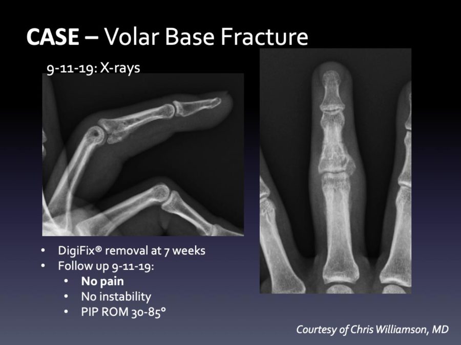 CASE: Delayed Dislocation