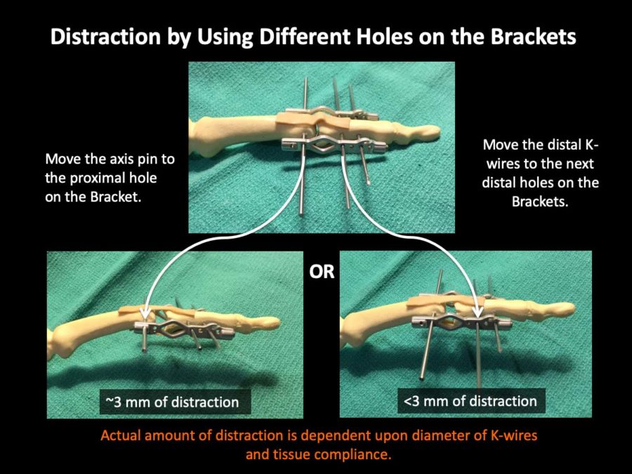 Distraction by Using Different Holes on the Brackets