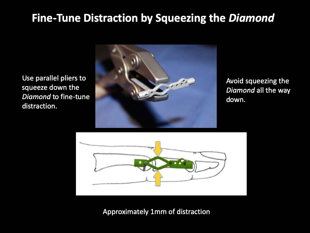 Fine-Tune Distraction by Squeezing the Diamond